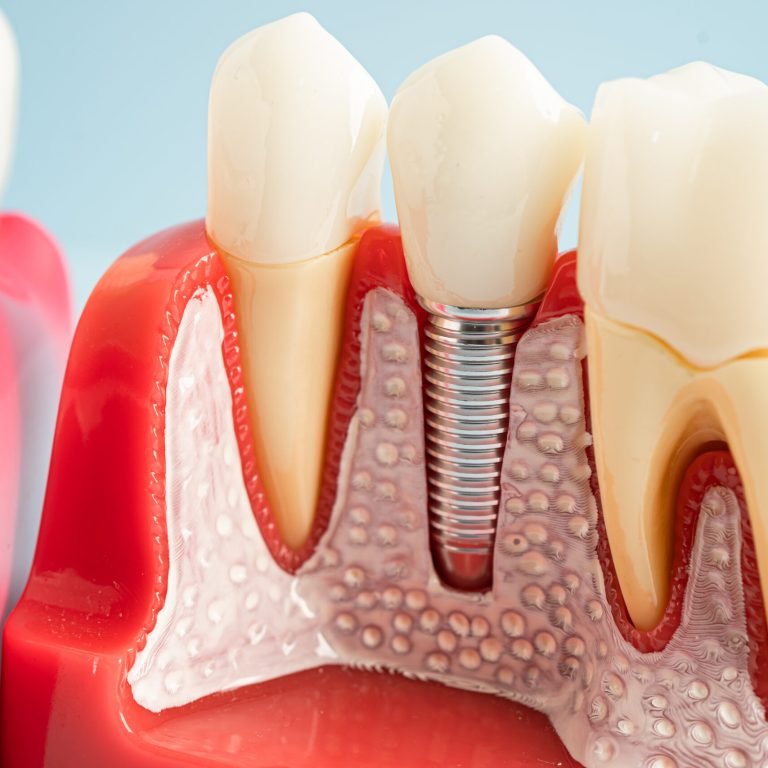 Dental implant, artificial tooth roots into jaw, root canal of dental treatment, gum disease, teeth model for dentist studying about dentistry.